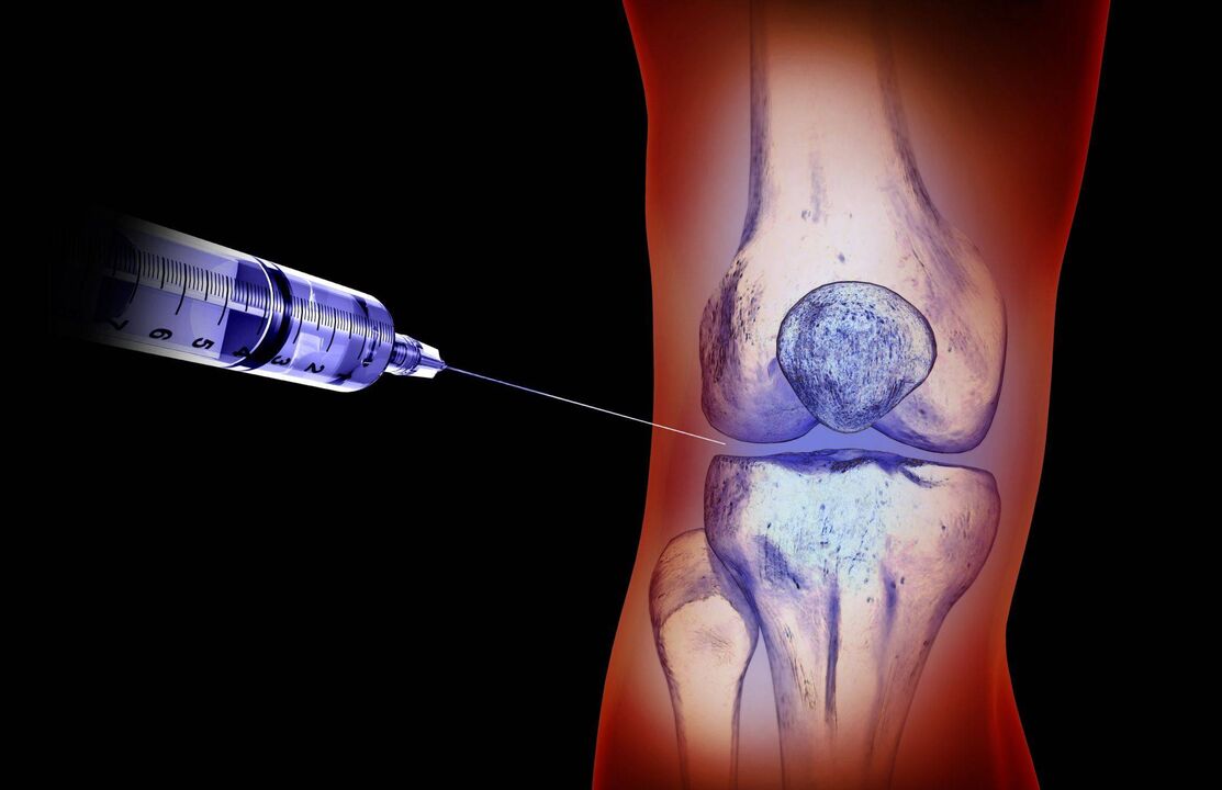 intra-articular injections for osteoarthritis