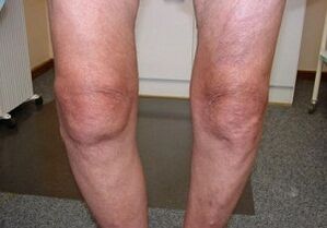 how to treat arthrosis of the knee joint