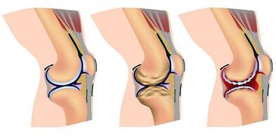 Phases of development of arthosis of the knee joint