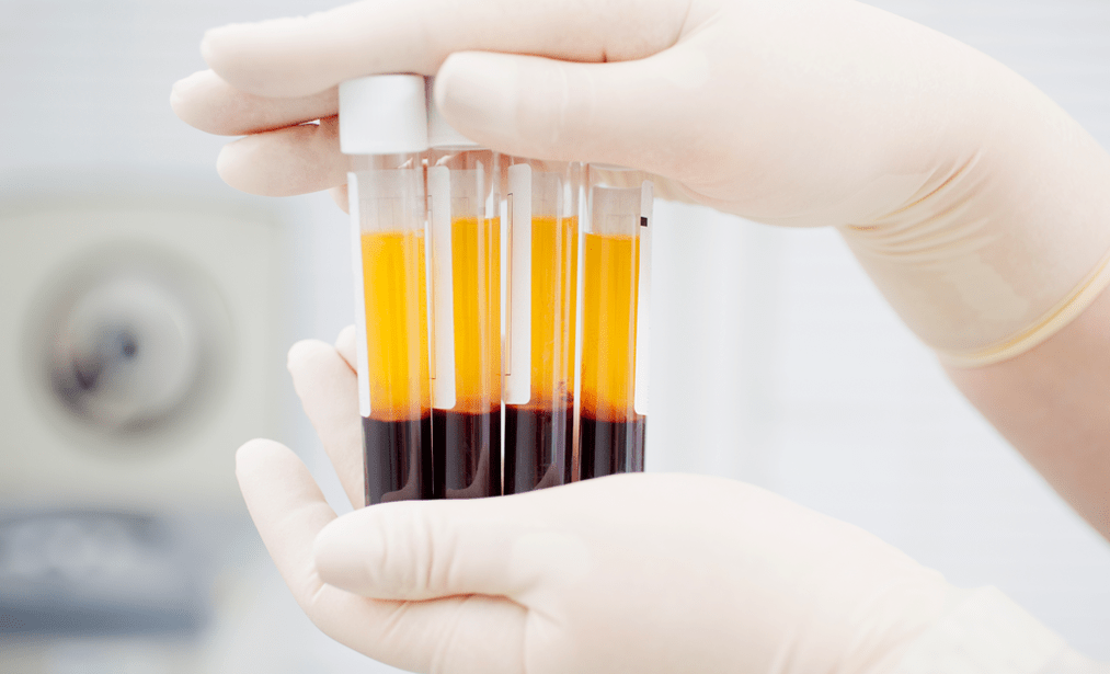 Platelet-rich plasma for PRP treatment against osteoarthritis