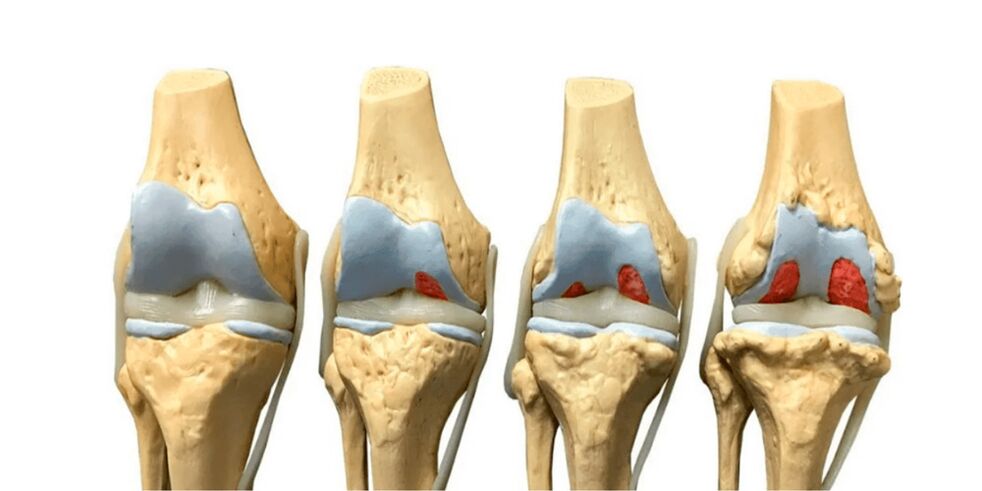 degree of osteoarthritis in the joints